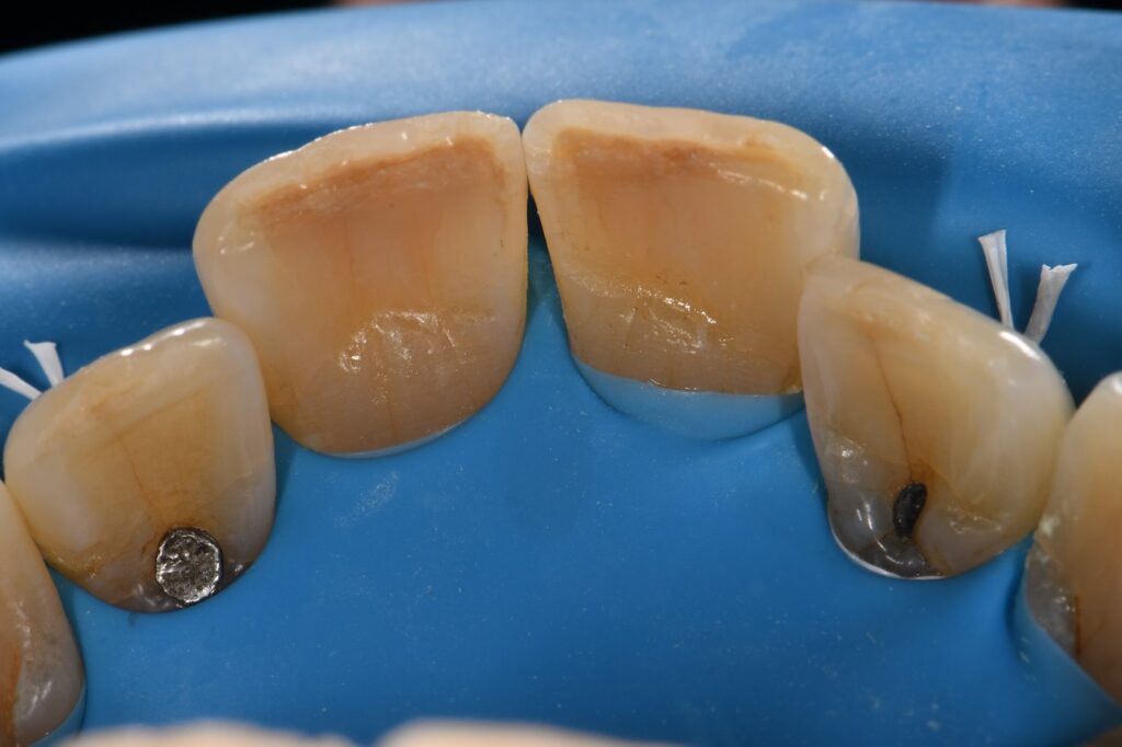 Amalgam Replacement Restorations