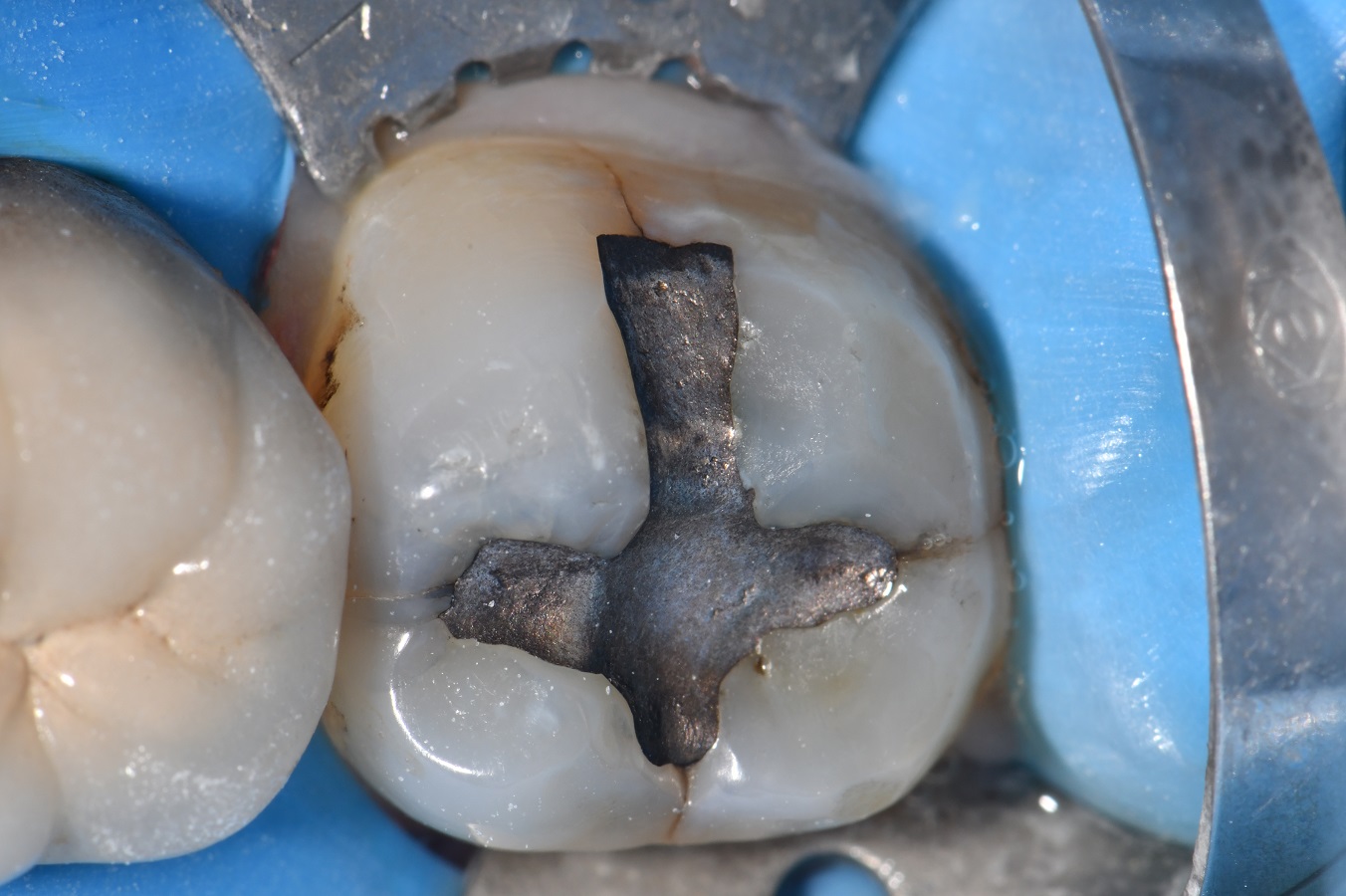 Supercomposite Restoration Of A Crack Compromised Tooth