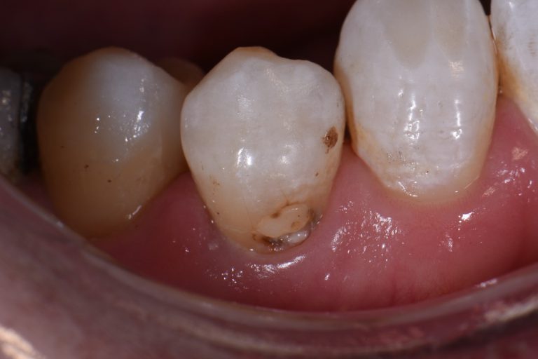 Chameleon Effect Restorations: Class V caries