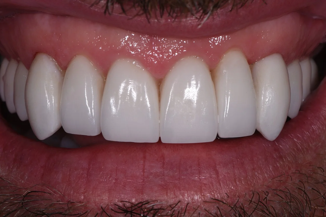 Vampire Teeth | Fang Feels | Cosmetic Dentist Auckland