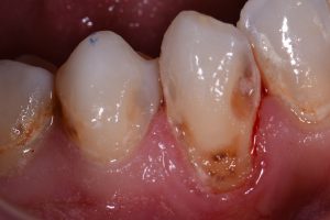 Cervical Caries | Cavities at the Necks of teeth