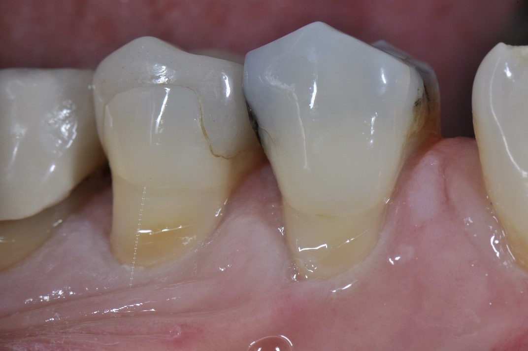 Cervical Abrasion | Composite Resin Restorations