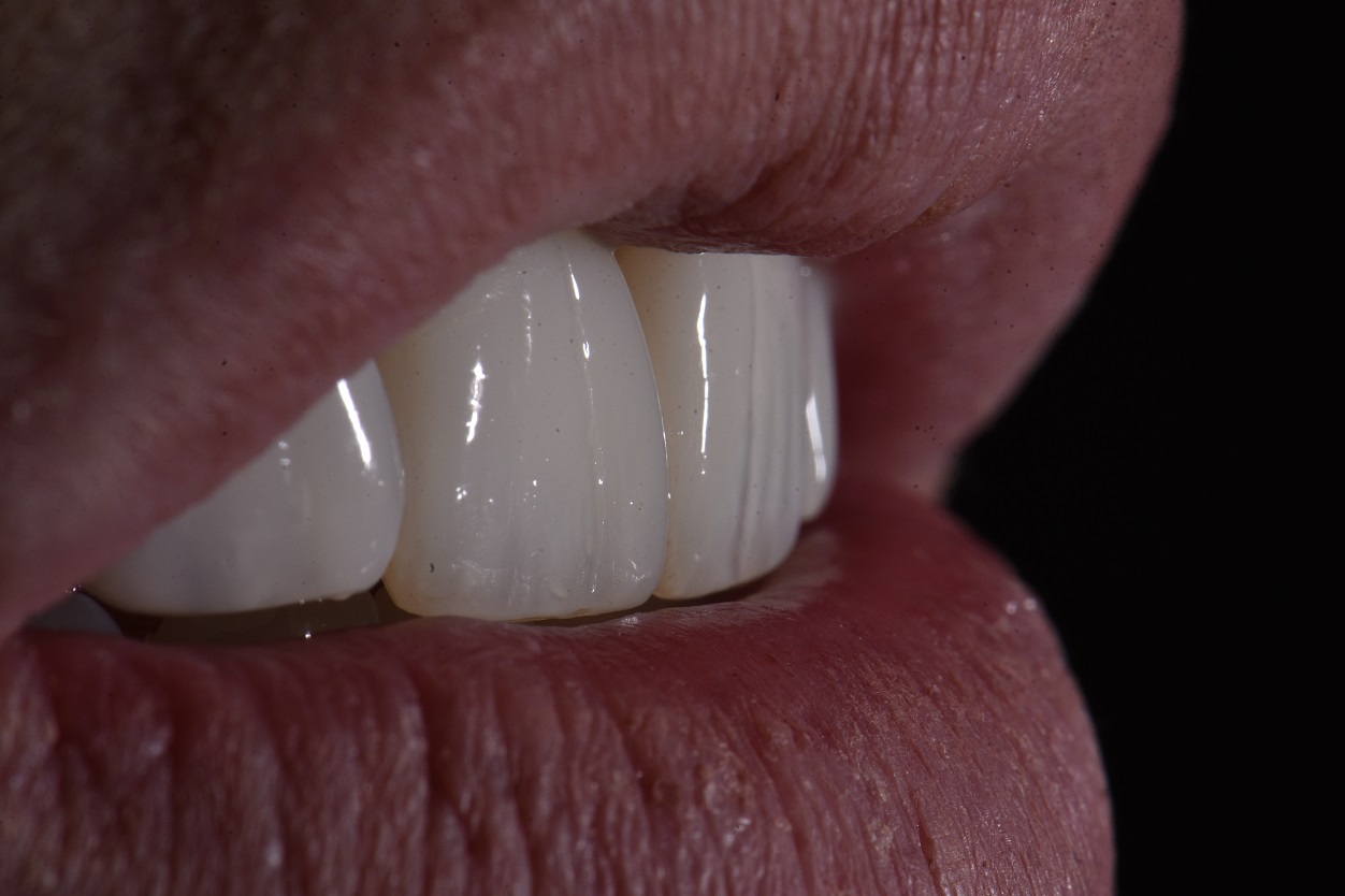 Correction of Missing Lateral Incisors Using Digital Smile Design