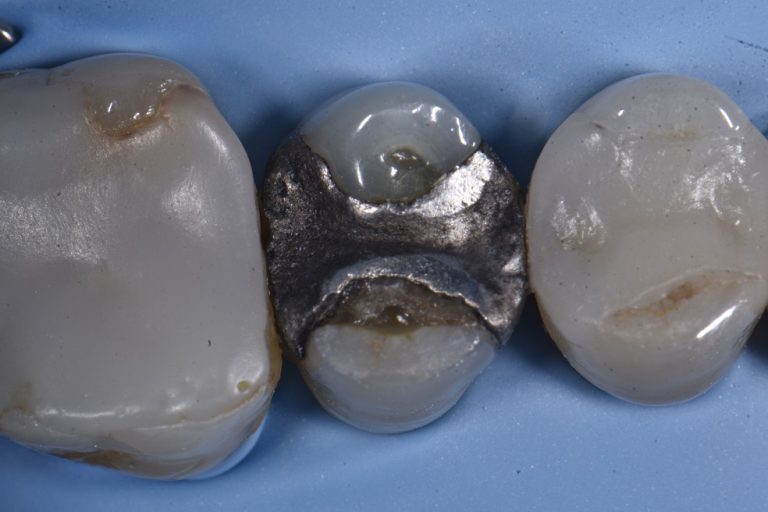 Leaking Amalgam Filling Replacements with Composite Resin