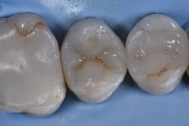 Leaking Amalgam Filling Replacements with Composite Resin