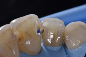 Class III caries | Restorative Dentistry Auckland