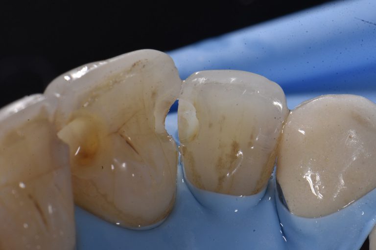 class-iii-caries-restorative-dentistry-auckland