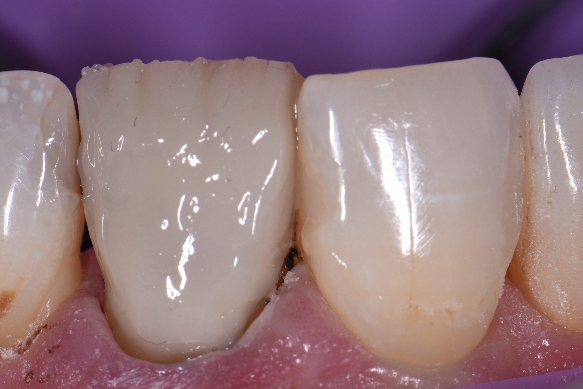 Lightening a dark tooth with composite resin artistry