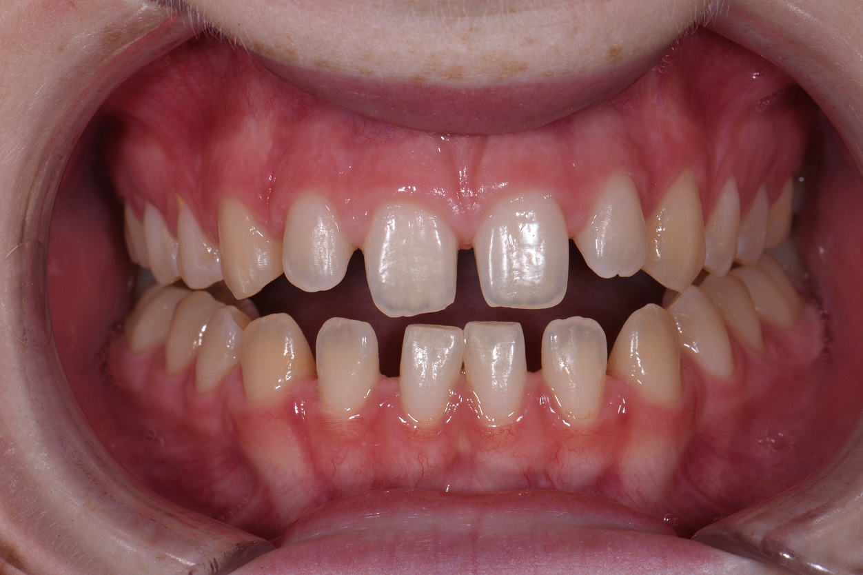 closing-spaces-between-teeth-microdontia-cosmetic-dentist-aacd