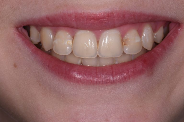 exposed-cavities-between-front-teeth-aacd-cosmetic-dentist-auckland