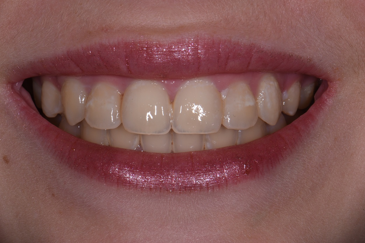 Exposed Cavities Between Front Teeth AACD Cosmetic Dentist Auckland