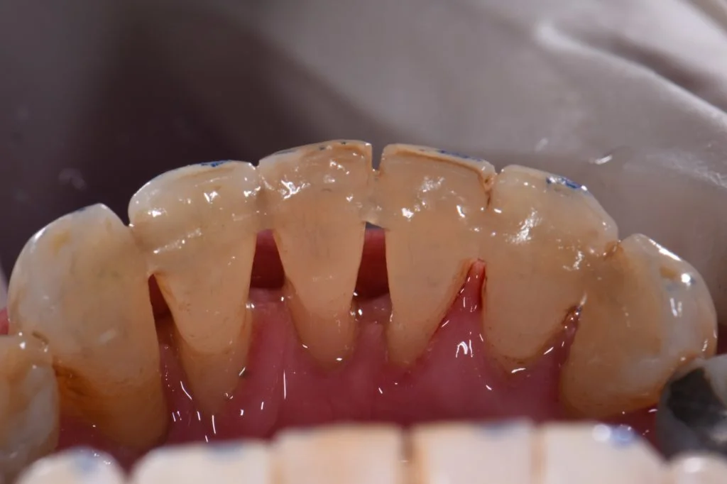 Stabilizing Mobile Teeth | Periodontal Splinting