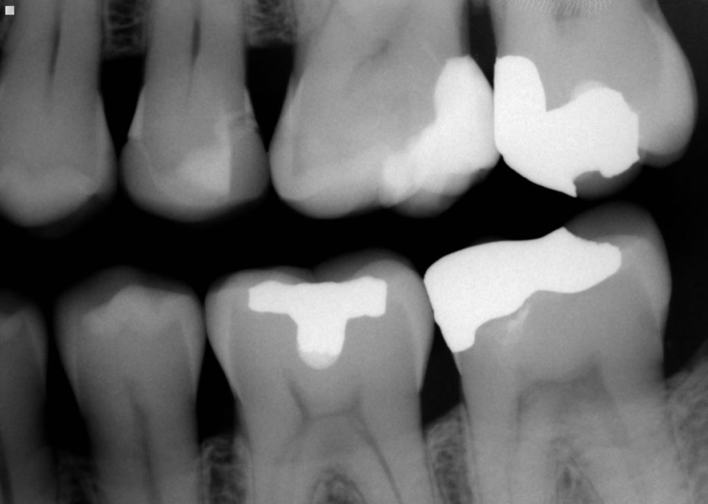 Restoring a fractured molar of a fellow dentist