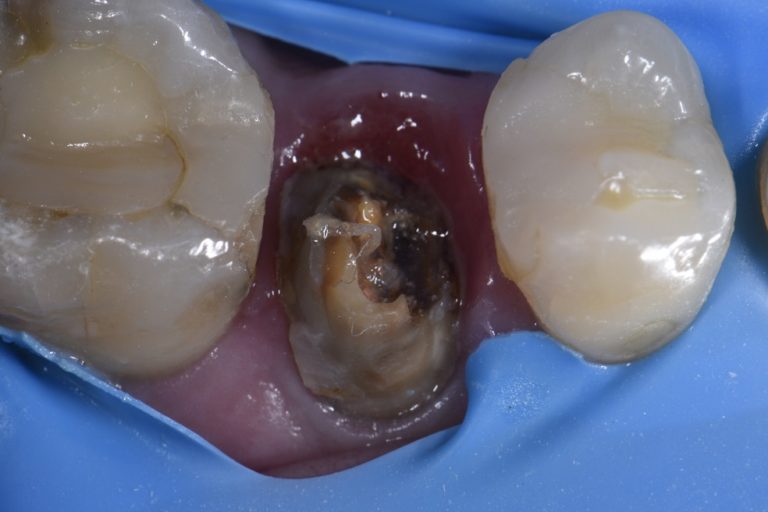 Rebuilding and Reconstructing Complex Teeth