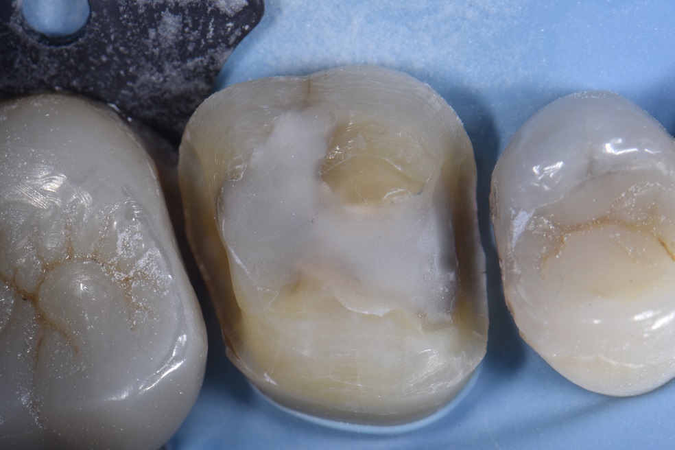 Adhesive Onlays in Restorative Dentistry