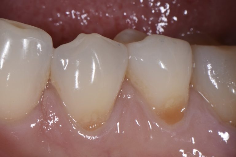 Class V Cervical Abrasion Restorations