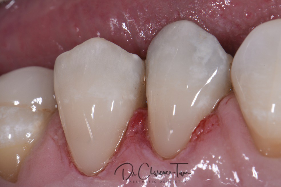 class-v-restorations-done-invisibly