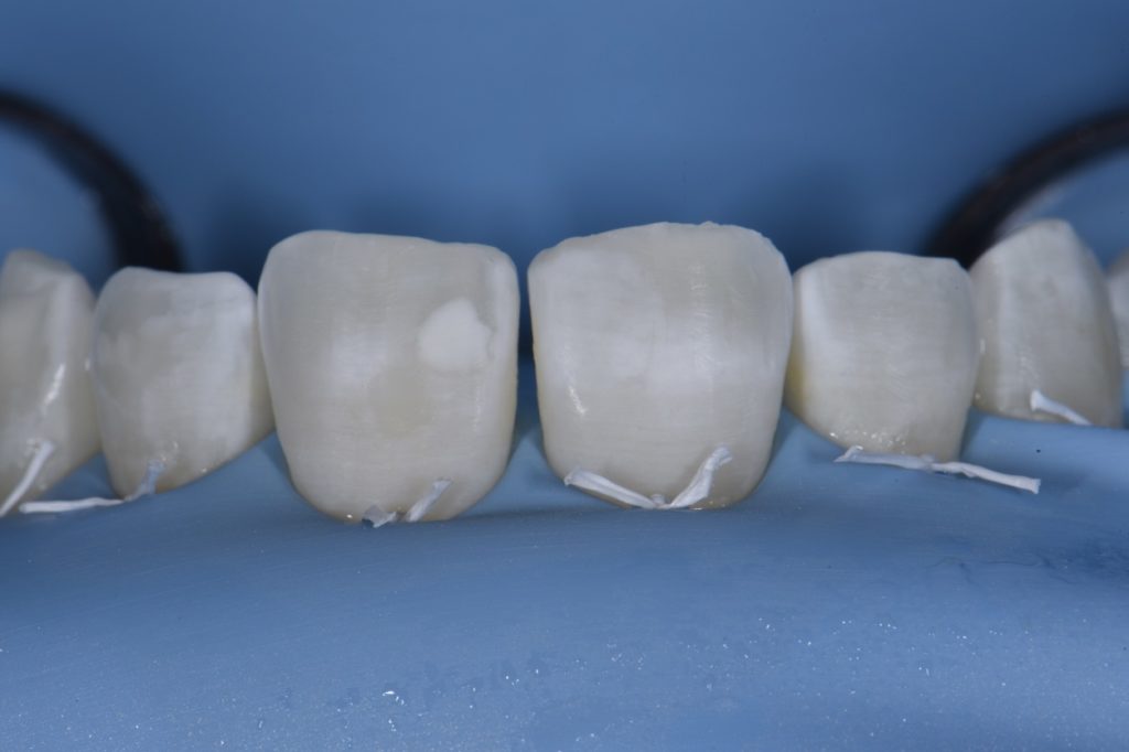 Post Orthodontic Composite Additions to Refine Smile Design