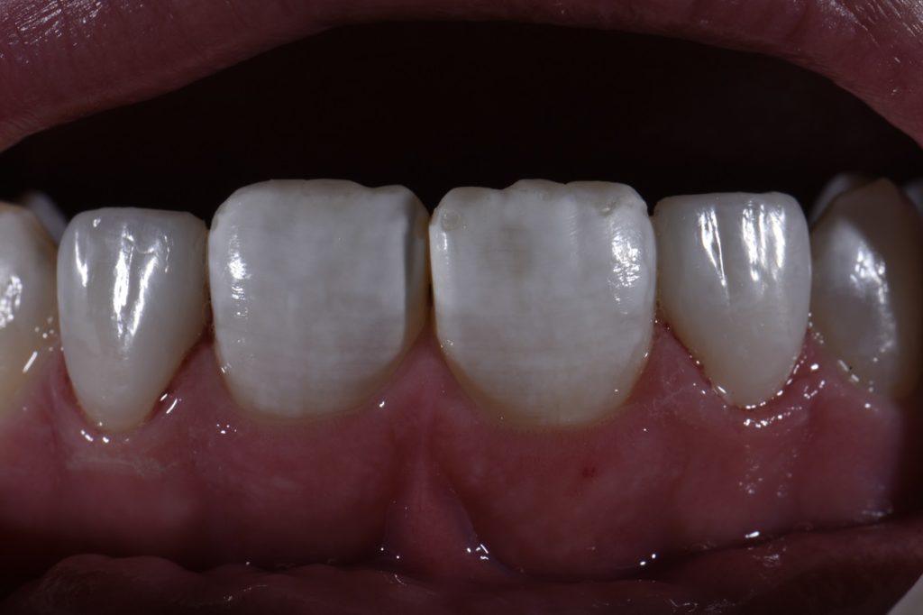 Peg lateral correction using non-invasive resin additions
