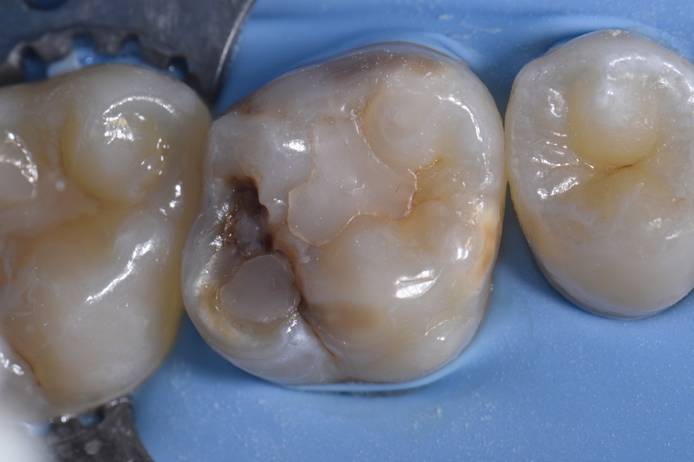 Managing A Hypomineralized Molar With Direct Resin