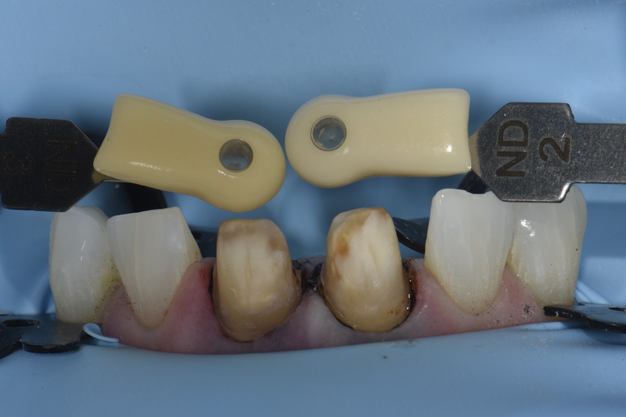 Workflow to Replace Two Old Crowns