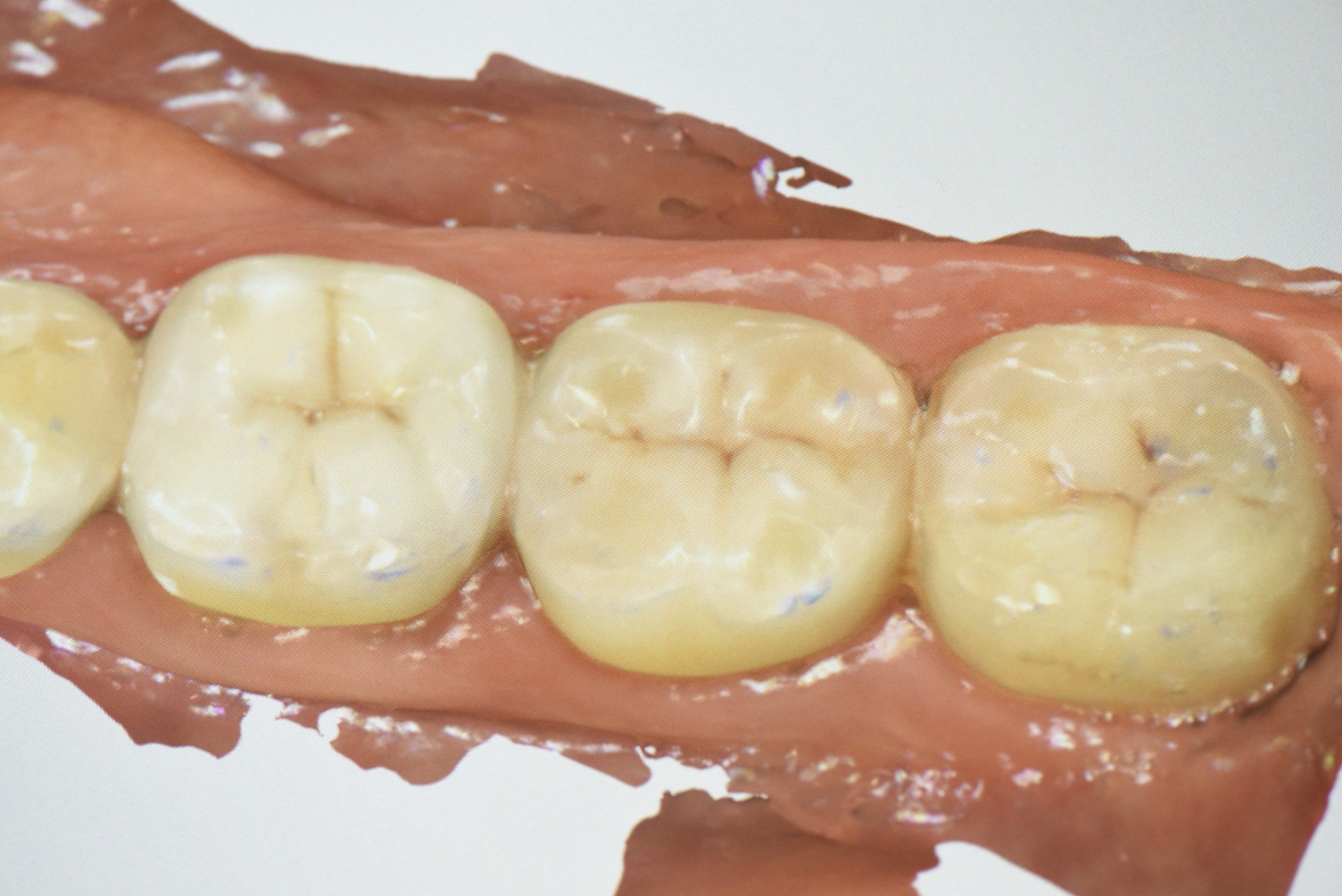 quadrant-dentistry-with-clinicians-choice-evanesce