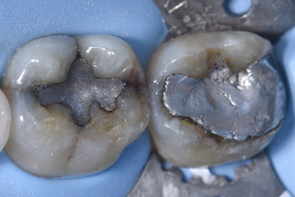 Large Amalgam-Induced Cracks Reversed