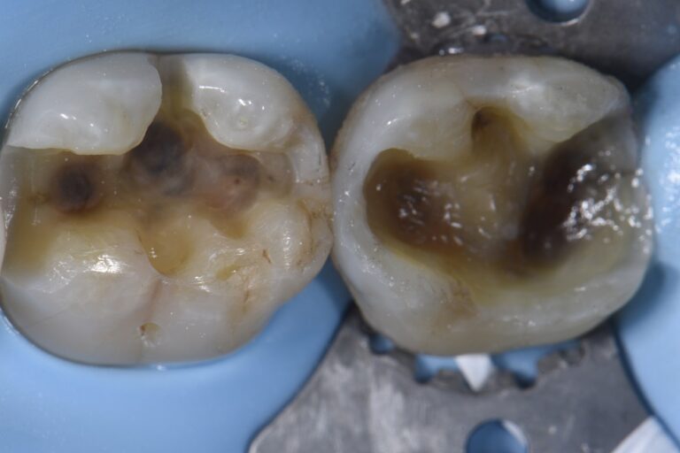 Large Amalgam-Induced Cracks Reversed