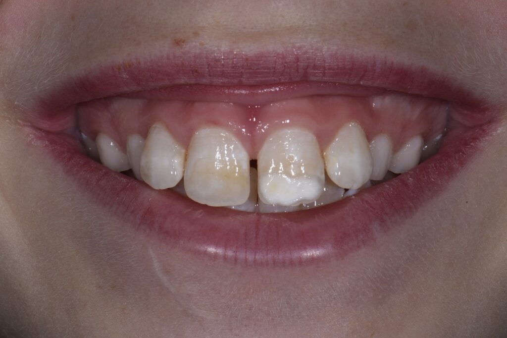 Resin Infiltration for Esthetic Improvement on a 9 year old