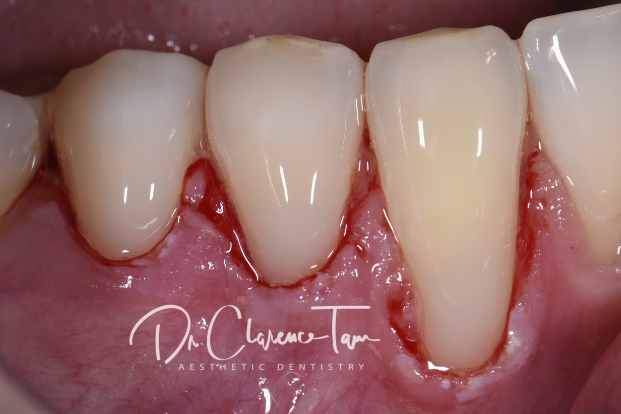 Root exposure and coverage with composite