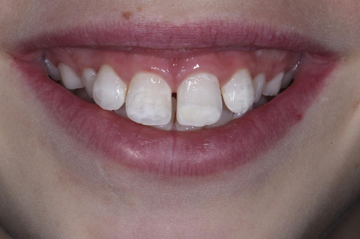 Resin Infiltration for Esthetic Improvement on a 9 year old