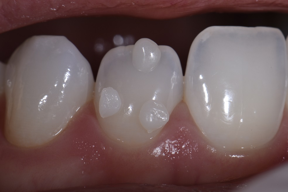 Non-invasive resin bonding to change shape of lateral incisor