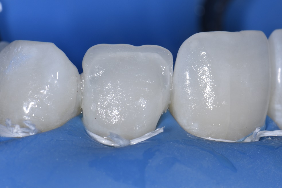 Non-invasive resin bonding to change shape of lateral incisor