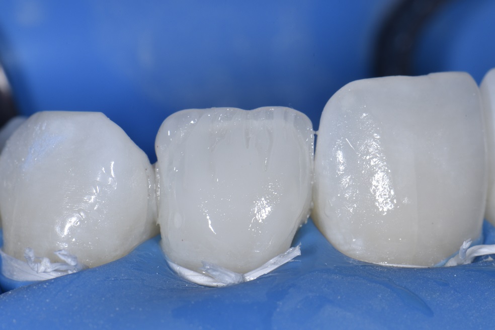 Non-invasive resin bonding to change shape of lateral incisor