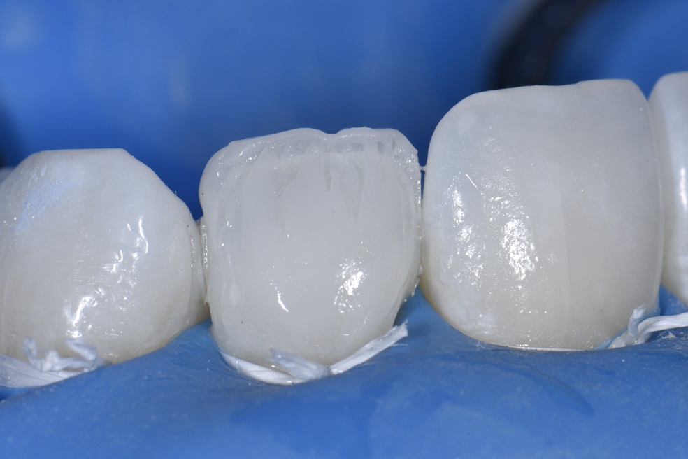 Non-invasive resin bonding to change shape of lateral incisor