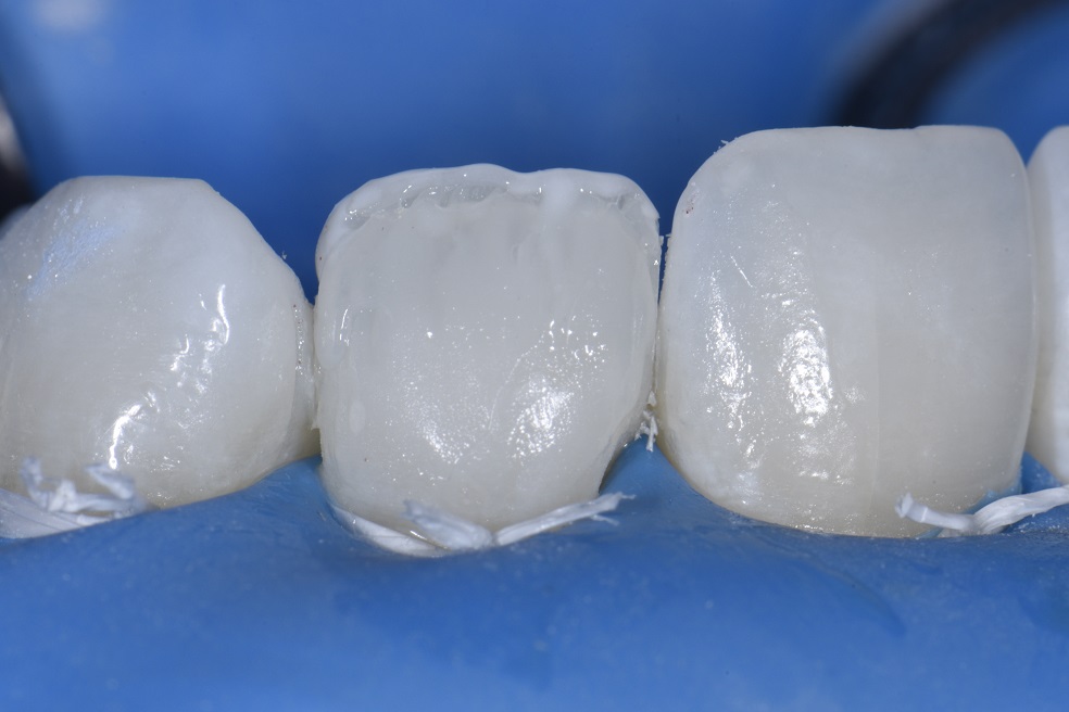 Non-invasive resin bonding to change shape of lateral incisor