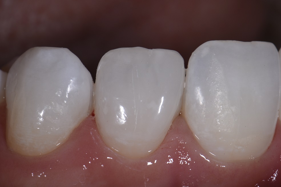 Non-invasive resin bonding to change shape of lateral incisor