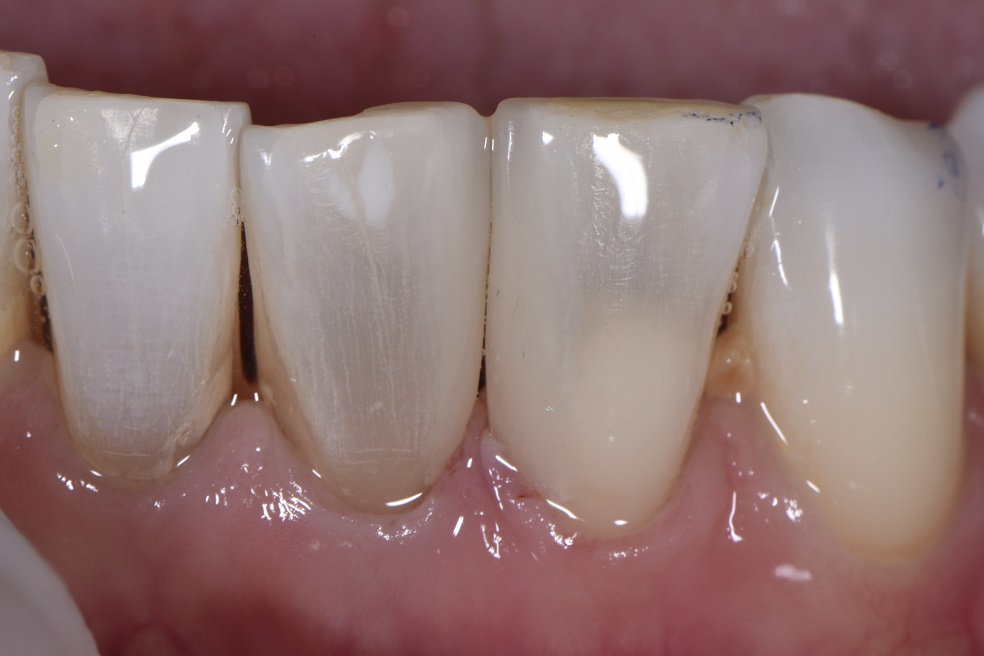 Large Diastema Closure with Composite Resin