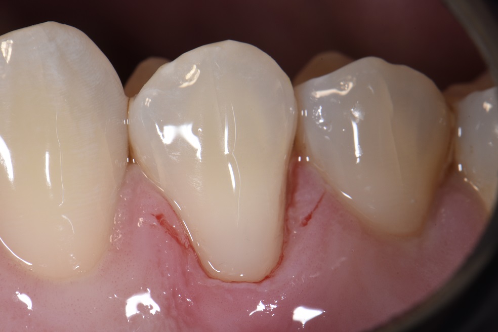 root-protection-using-composite-resin