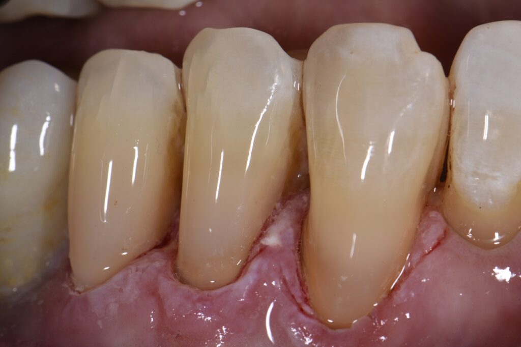 What Is Abrasion In Dental at dorissmattos blog