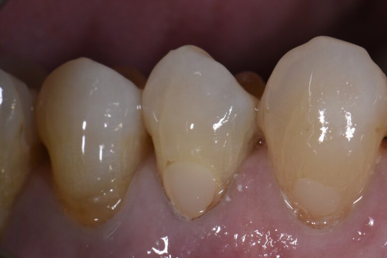 class-v-replacement-restorations-root-lightening