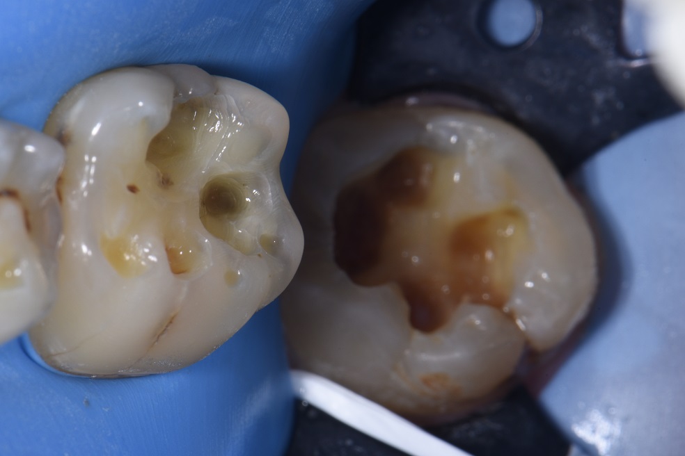 Restoring angled wisdom teeth cavities