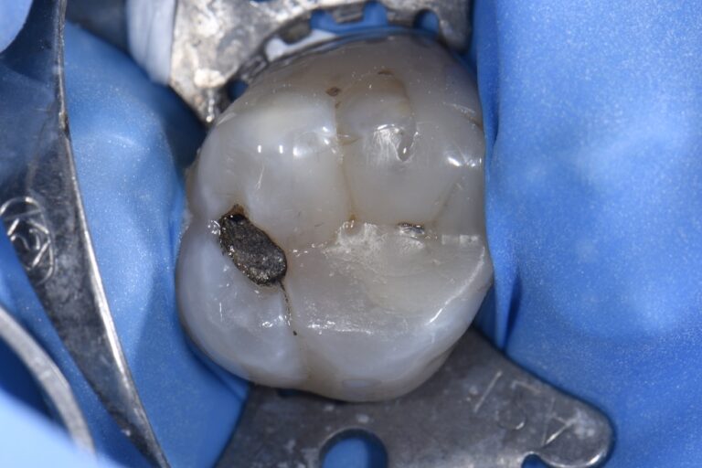 Amalgam Removal