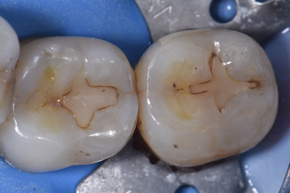 Minimal Invasion Replacements of Old Shallow Restorations