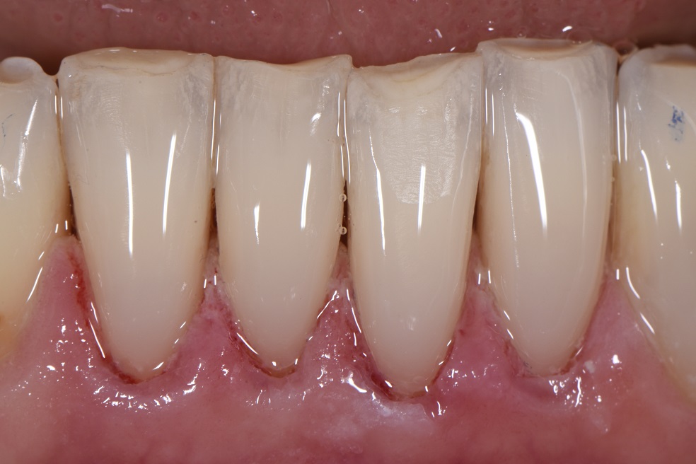 Lower incisor cervical abrasion lesions