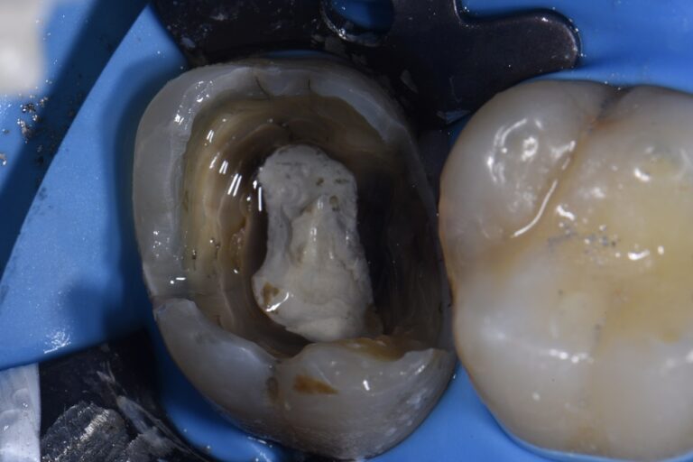 Bonded Core Support for Compromised Teeth