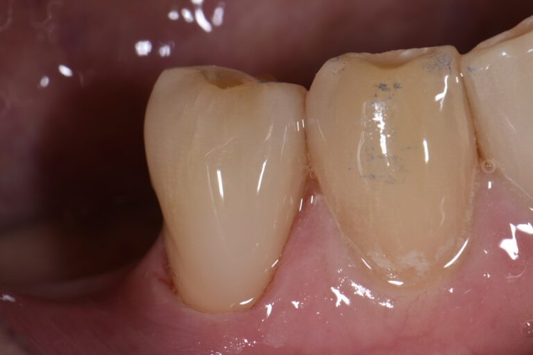 cavities-on-the-root-surface