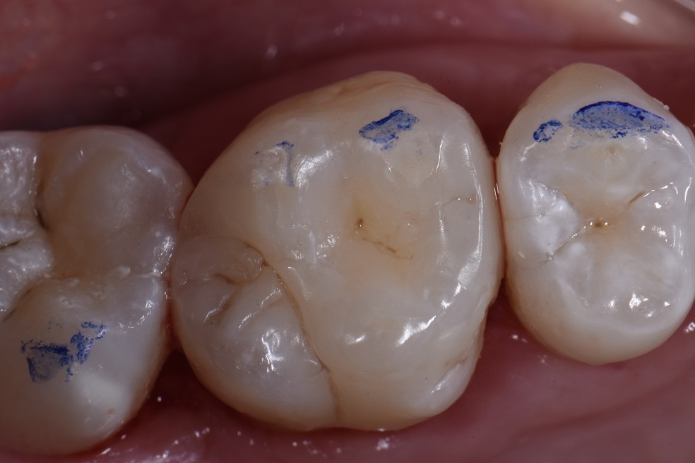 Biomimetic Composite Restorations