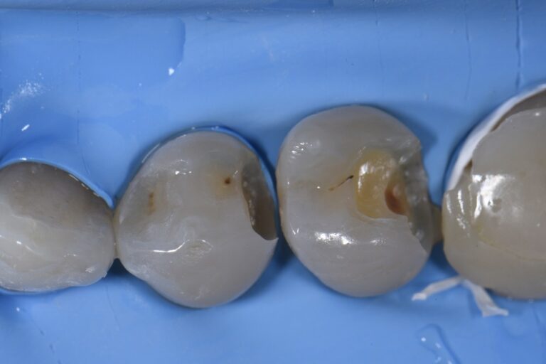 Chameleon Composites Invisible Resin Restorations