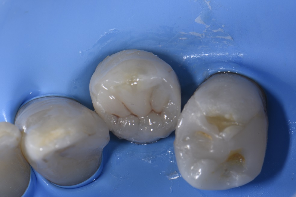 Large MOD on first premolar composite filling